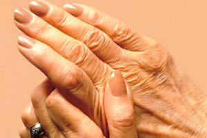 ρευματοειδή αρθρίτιδα