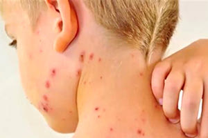 κρούσματα ιλαράς