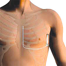 Ο υποδόριος απινιδωτής 