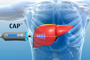 ΠΑΓΝΗ: Για όλη την Κρήτη το μηχάνημα που “καταργεί” τη βιοψία ήπατος