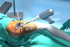 Αρθροπλαστική ισχίου σε εικονική πραγματικότητα