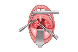 αφαίρεση των αμυγδαλών (αμυγδαλεκτομή)