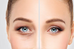 Βλεφαροπλαστική χωρίς νυστέρι