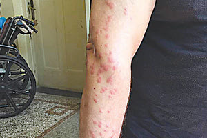 Αποτροπιασμός από την επίθεση των κοριών στα χέρια του κρατούμενου