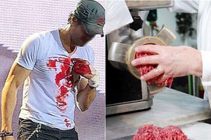 έχασε τα 4 δάκτυλά του στη μηχανή του κιμά