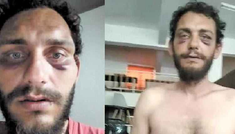 Ο 38χρονος που κατήγγειλε ότι έπεσε θύμα αστυνομικής βίας από δύο δικυκλιστές αστυνομικούς της Ομάδας ΔΙΑΣ στον κεντρικό δρόμο της Αμμουδάρας