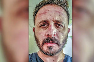 Ο κ. Φασουλάκης έχει εμφανή τα σημάδια της μάσκας στο πρόσωπό του