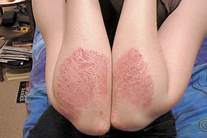 Έξαρση της ψωρίασης