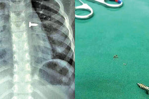 Αφαίρεσαν βίδα από τον πνεύμονα τρίχρονου κοριτσιού