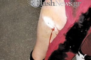 επίθεση σκύλου σε γυναίκα