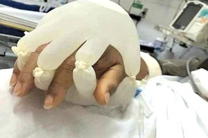 «Το χέρι του Θεού» στη Βραζιλία όπου γεμίζουν γάντια με ζεστό νερό και τα τοποθετούν στις παλάμες των ασθενών με Covid 