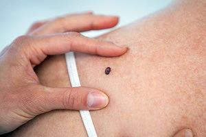 “ΑΓΚΑΛΙΑΖΩ” Εβδομάδα ενημέρωσης για τον καρκίνο του δέρματος