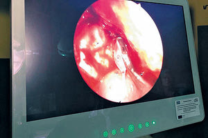 Πρωτοποριακή επέμβαση με ενδοσκοπική αφαίρεση όγκου στο ΠΑΓΝΗ