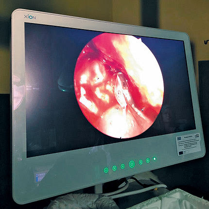 Πρωτοποριακή επέμβαση με ενδοσκοπική αφαίρεση όγκου στο ΠΑΓΝΗ