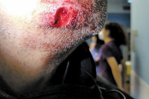 Η «Ελπίδα» ανέβαλε το… Αυτόφωρο για το δαγκωμένο πηγούνι