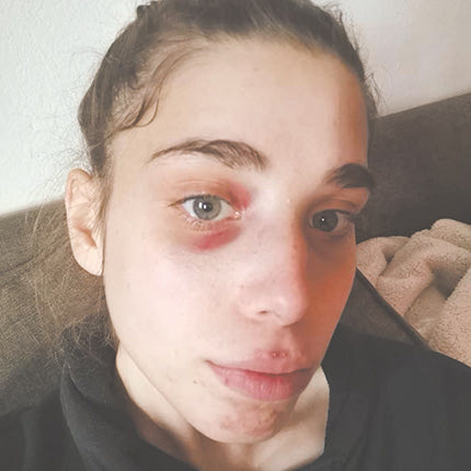 Η 19χρονη Δήμητρα Σακαδάκη μετά το σκηνικό με τον “τσαντάκια”. Τη φωτό ανάρτησε στο facebook ο πατέρας της, προτρέποντας τα παιδιά να ασχοληθούν για την προστασία και την ασφάλεια τους με τις πολεμικές τέχνες.