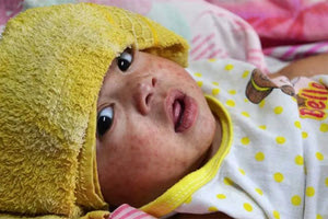 Η ιλαρά θεωρείται η πιο μεταδοτική ιογενής νόσος και είναι ιδιαίτερα επικίνδυνη για τα βρέφη και τα νήπια.