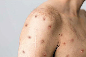 Επί ποδός ο ΕΟΔΥ για ύποπτο κρούσμα στην Ελλάδα