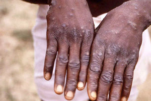 κρούσματα ευλογιάς των πιθήκων