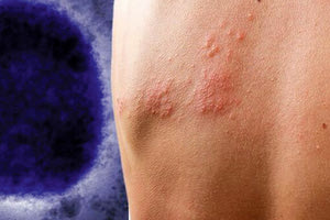 κρούσματα ευλογιάς πιθήκων