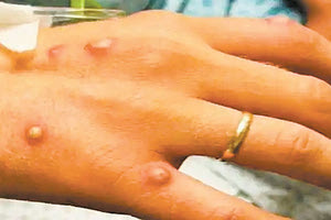 Ο ΕΟΔΥ προχωρά σε τακτική ενημέρωση για την πορεία της ευλογιάς των πιθήκων στη χώρα μας κάθε Πέμπτη