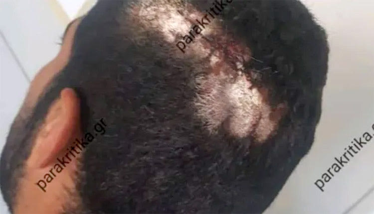 Χτυπήματα στο κεφάλι φέρει ο Αιγύπτιος σύμφωνα με την φωτογραφία από τα parakritika.gr