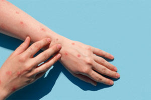 Ευλογιά των πιθήκων: «Ήταν οι χειρότεροι πόνοι που έχω νιώσει ποτέ στη ζωή μου»