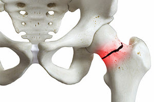 κάταγμα ισχίου