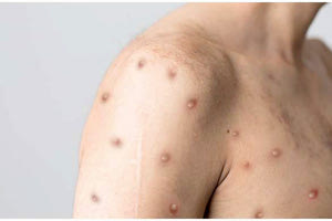 κρούσματα ευλογιάς πιθήκων