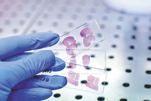 Το 20%-35% των βιοψιών αφορούν κακοήθειες και η αναμονή για τα αποτελέσματα φθάνουν τον 1 μήνα