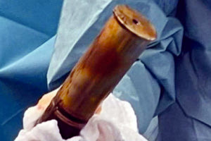 ΓΑΛΛΙΑ: Πήγε στα επείγοντα με οβίδα του Α’ Παγκοσμίου στον... πρωκτό του