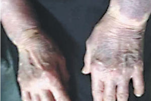 ΗΛΙΚΙΩΜΕΝΗ