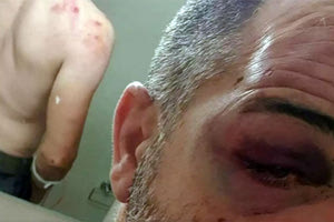 Εμφανή τα σημάδια του ξυλοδαρμού στο σώμα και το πρόσωπο του 45χρονου (σύμφωνα με τη φωτό του cna.gr)