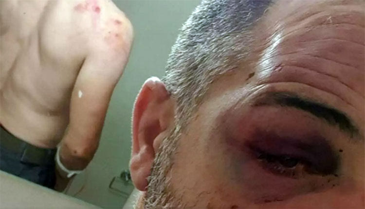 Εμφανή τα σημάδια του ξυλοδαρμού στο σώμα και το πρόσωπο του 45χρονου (σύμφωνα με τη φωτό του cna.gr)