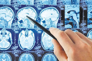 Κρίσιμος παράγοντας ο χρόνος για τα εγκεφαλικά επεισόδια