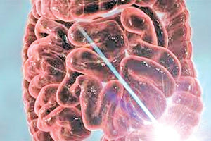 Μείωση της συχνότητας καρκίνου του παχέος εντέρου στις μεγαλύτερες ηλικίες, αύξηση στις νεότερες