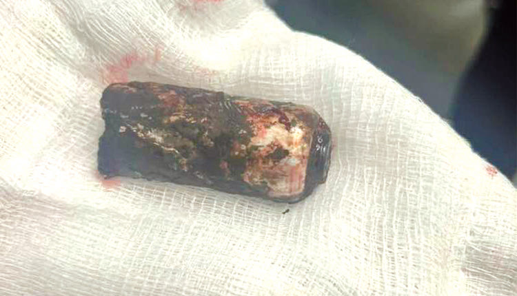 Η βολίδα που αφαίρεσαν οι γιατροί