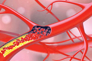 ΕΟΦ: Οδηγίες στους γιατρούς για τη χρήση φαρμάκου για τη χοληστερίνη μετά από αναφορές για πρόβλημα