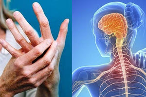 Ελπίδες για θεραπεία της σκλήρυνσης κατά πλάκας από ένα νέο φάρμακο!