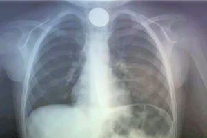 Το παιδί κατάπιε ένα κέρμα