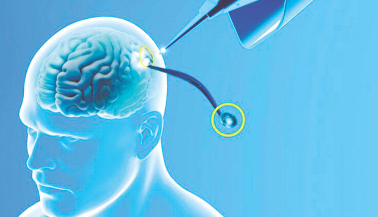 Η μεταμόσχευση έγινε την περασμένη Κυριακή και ο ασθενής αναρρώνει ομαλά, ανέφερε ο Μασκ 