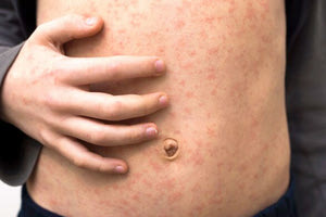 Συναγερμός για την επανεμφάνιση της ιλαράς και στην Κρήτη