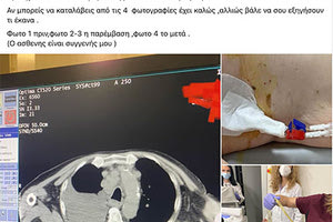Δεν πήγε να ψηφίσει ο Πολάκης για τα ομόφυλα ζευγάρια. Επικαλέστηκε χειρουργείο συγγενικού του προσώπου. Και επειδή τον σχολίασε ο κ.Μητσοτάκης έκανε νέα ανάρτηση με… αποδείξεις, όπως λέει: