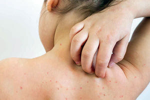 Τι συνιστά η εγκύκλιος που έφτασε στα σχολεία για την ιλαρά