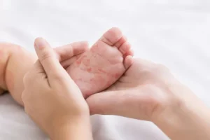 Σε ποιες χώρες καταγράφεται έξαρση ιλαράς