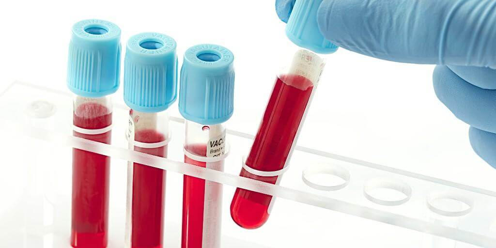 Μελέτη: Απλή αιματολογική εξέταση μπορεί να προβλέψει την καρδιακή προσβολή