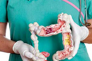 Καρκίνος εντέρου