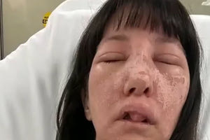 Γεωργία: Γυναίκα δέχθηκε επίθεση από δηλητηριώδεις αράχνες και παραμορφώθηκε το πρόσωπό της