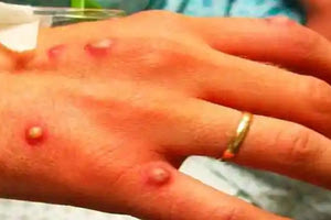 Παγώνη: Ποια η διαφορά μεταξύ ευλογιάς των πιθήκων και ανεμοβλογιάς Τι ανέφερε η πρόεδρος της ΕΙΝΑΠ