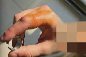 Χαλκιδική: Γιατροί έψαχναν στο Youtube πώς να αφαιρέσουν δαχτυλίδι από δάχτυλο ασθενούς και τελικά φώναξαν ηλεκτρολόγο!